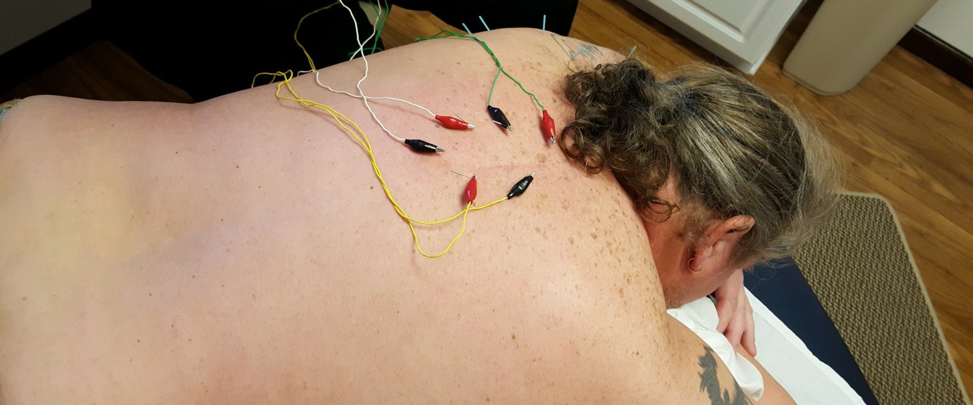 What Does Acupuncture Really Do?