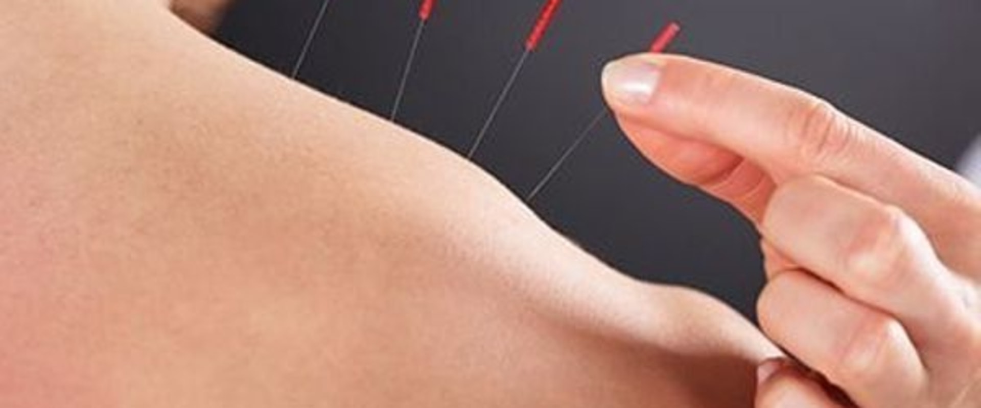 Can I Receive Acupuncture with a Pacemaker or Other Implanted Device?