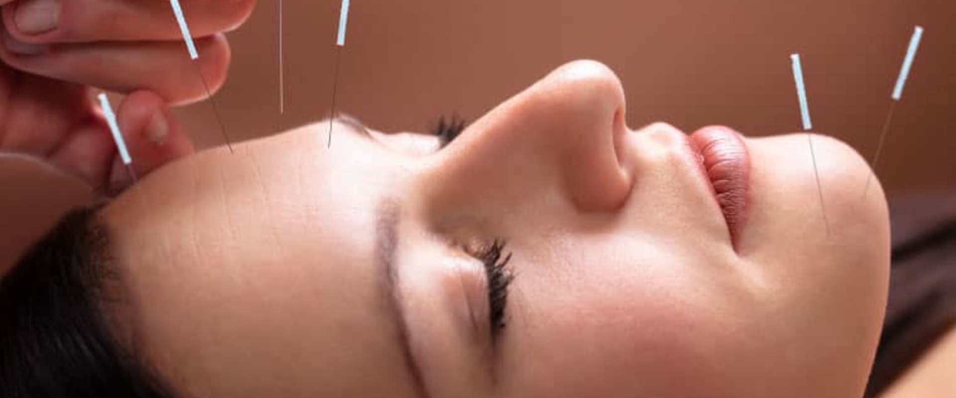 Discover the Benefits of Anti-Aging Acupuncture in Hillarys