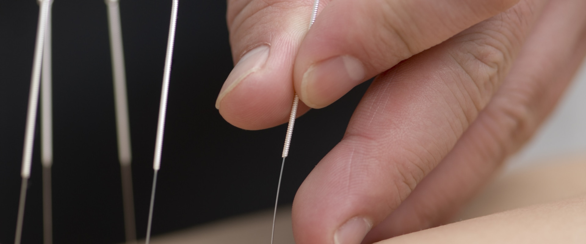 Who Should Not Get Acupuncture?