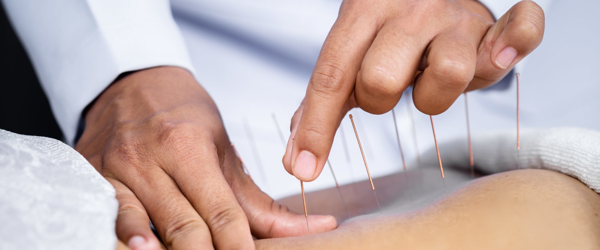 What Conditions Can Be Treated with Acupuncture?