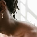 San Diego Acupuncture: Finding A Naturopathic Doctor For Personalized Treatment