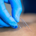 Discover How Awake Lipo Complements Acupuncture in Arizona