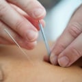 Unraveling the Mystery of Acupuncture: How Does it Work Step by Step?