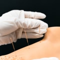 Discover the Benefits of Acupuncture in Inpatient Drug Rehab