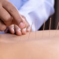 How Long Does an Acupuncture Session Last?