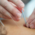 How Long Does an Acupuncture Session Last?