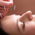 Discover the Benefits of Anti-Aging Acupuncture in Hillarys