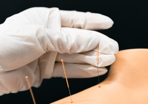 Discover the Benefits of Acupuncture in Inpatient Drug Rehab