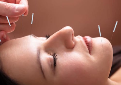 Discover the Benefits of Anti-Aging Acupuncture in Hillarys